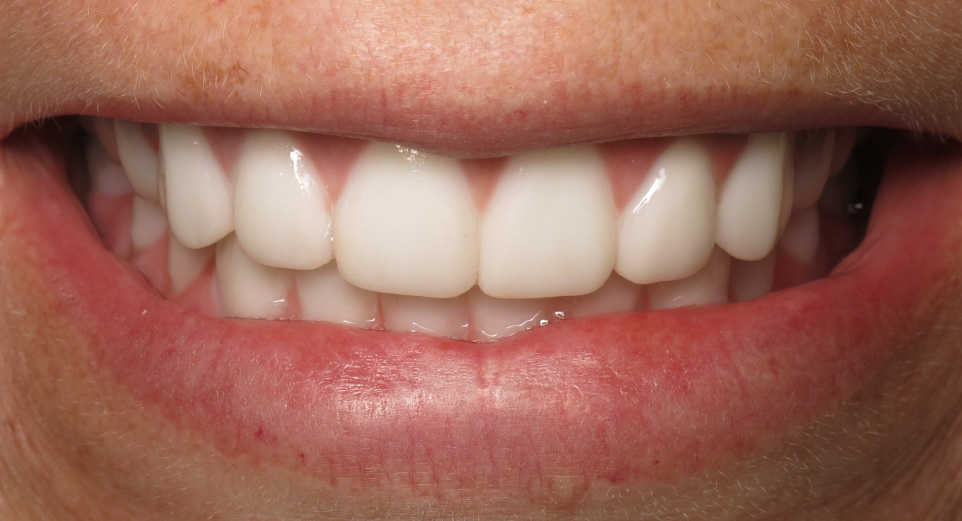 After BarZero Zirconia Installation